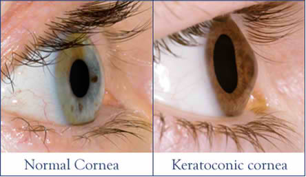 Photo shows a Normal cornea and a Keratoconic cornea