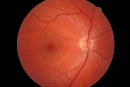 Digital photo of a Retina